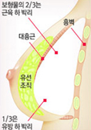 이중평면(듀얼플레인) — 보형물 삽입 위치