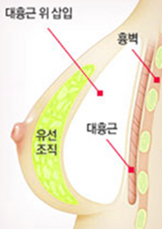 유선下 — 대흉근 위 보형물 삽입