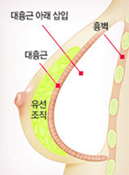 근육下 — 대흉근 아래 보형물 삽입