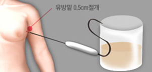 지방흡입 수술 방법