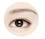 뒤트임 1단계