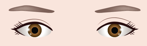 재수술 3단계