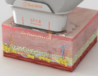 SHURINK L7-1.5, 1.5mm 깊이