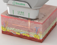 SHURINK L7-3.0, 3.0mm 깊이