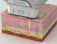 SHURINK L4-4.5, 4.5mm 깊이