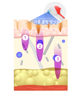 프라임 포커싱 RF 이중 쿨링 시술