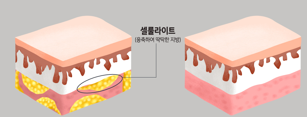 셀룰라이트 BEFORE AFTER 비교