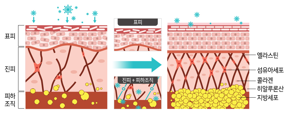 엑소좀 시술 전후 피부층 변화 — 표피·진피·피하조직, 콜라겐·엘라스틴·섬유아세포