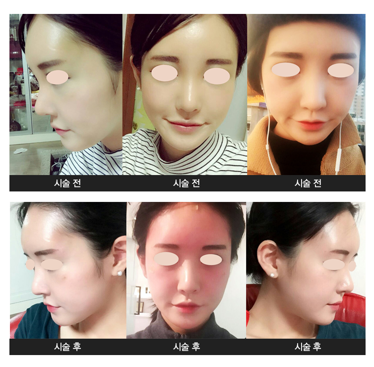 엘란쎄 필러 이마 시술 전후 — 측면·정면 비교