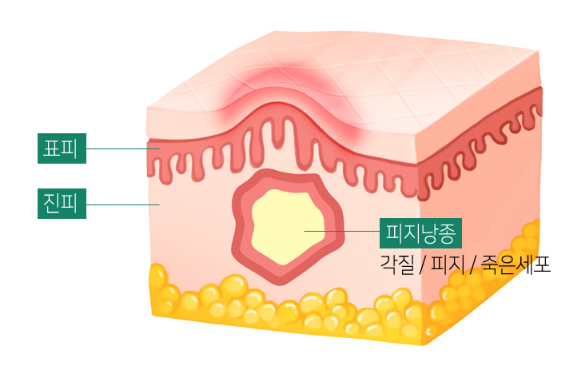 피지낭종 구조 설명도