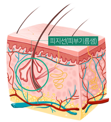 피지낭종 원인 설명도