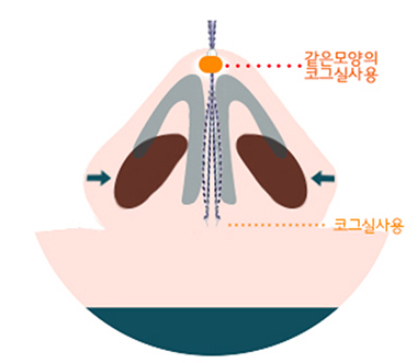 기존 코리프팅 시술 — 코그실 배치 도식
