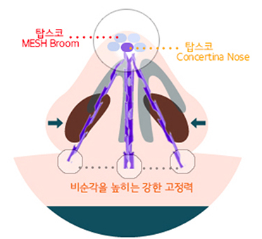 탑스코 Tripod concept 시술 — Mesh Broom·Concertina Nose