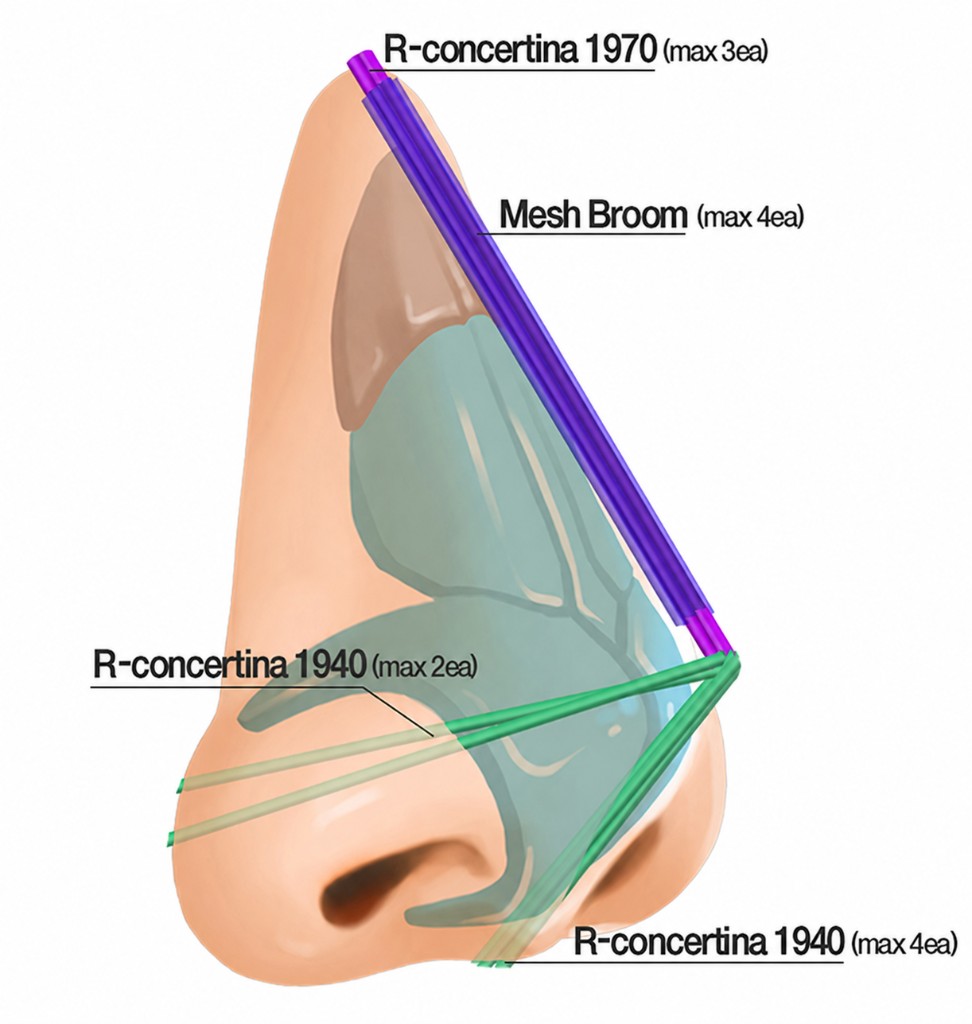 탑스코 Tripod concept — Mesh Broom·R-concertina 실 배치 도식