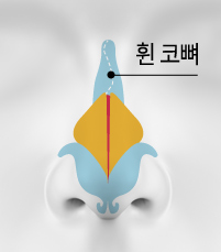 CASE 01 STEP 01 — 휜 코뼈