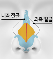 CASE 01 STEP 02 — 바깥 절골