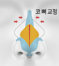 CASE 01 STEP 04 — 코뼈 교정